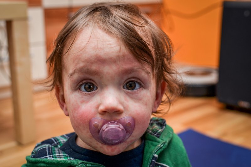 The 3 Cs of Measles